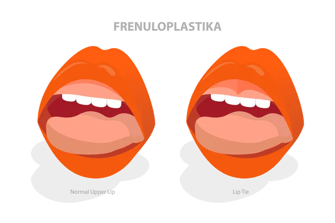 3 D Isometric Flat Vector Illustration Of Frenuloplastika Lip Tie Before And After Surgery イラスト