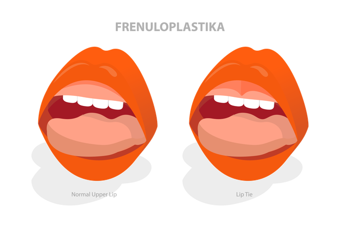 Lip Tie Before and After Surgery  일러스트레이션