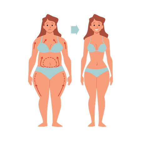 Liposuction and aesthetic plastic surgery  Illustration