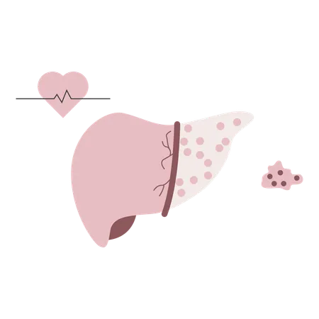 Liver cancer disease  Illustration