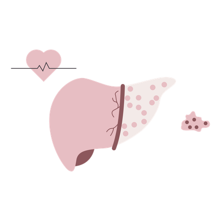 Liver cancer disease  Illustration