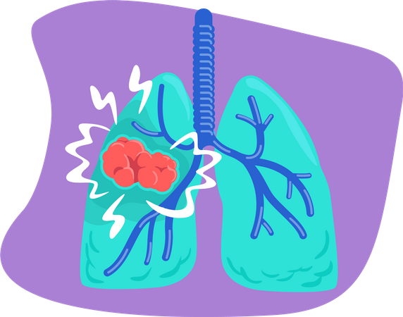 Lung cancer Illustration