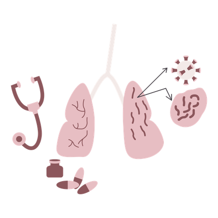 Lung cancer disease  Illustration