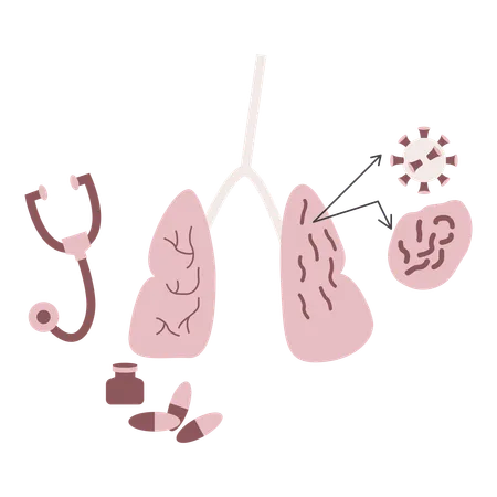 Lung cancer disease  Illustration