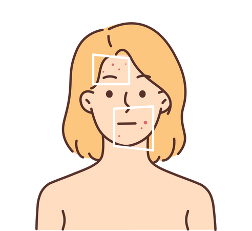 Mädchen mit Anzeichen von Akne im Gesicht  Illustration