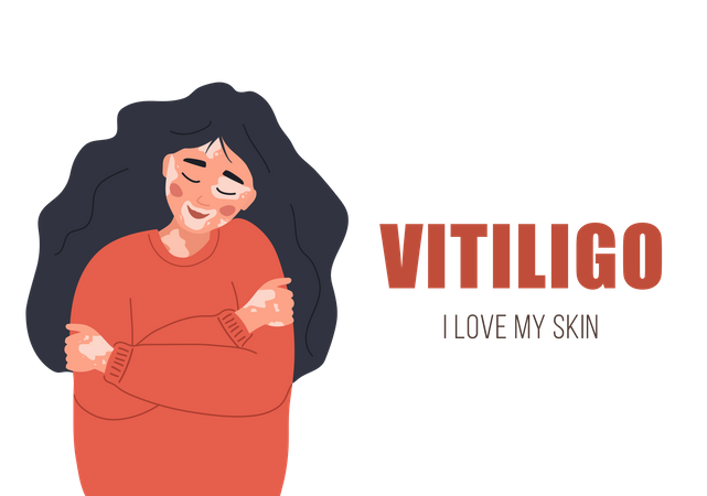 Mädchen mit Vitiligo  Illustration