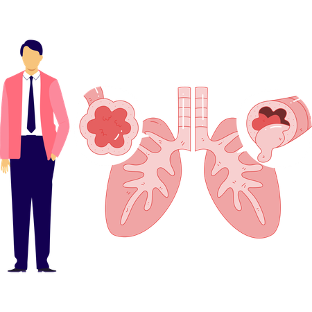 Male doctor research on bronchitis problem  Illustration