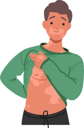 Joyful Man Proudly Showcasing His Vitiligo Embracing Diversity And Radiating Happiness His Positive Spirit Promotes Self Love And Acceptance In A World Of Uniqueness Cartoon Vector Illustration イラスト