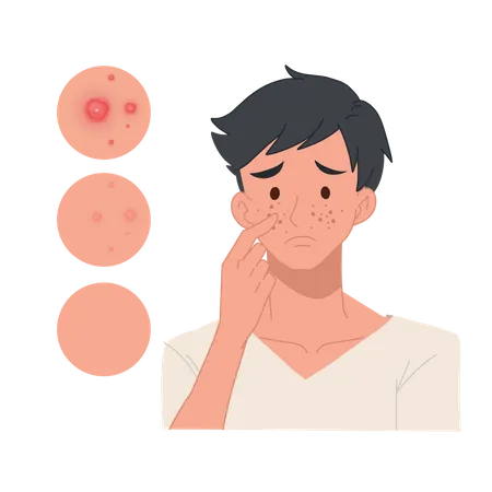 Problem Skin Concept Man With Pimples On His Face Facial Skin Troubled Flat Vector Cartoon Character Illustration Illustration