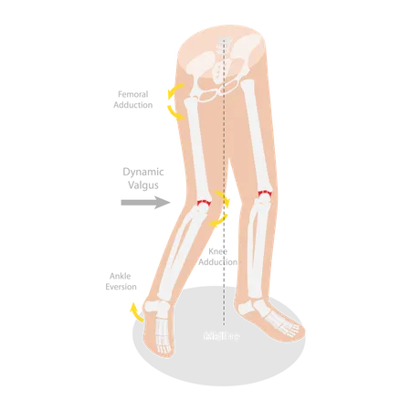 Mécanisme de blessure ACL  Illustration