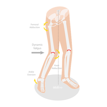 Mechanism Of Acl Injury  イラスト