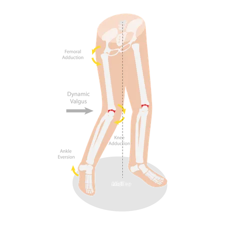 3 D Isometric Flat Vector Conceptual Illustration Of Mechanism Of Acl Injury Labeled Educational Diagram Illustration