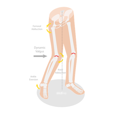 Mechanism Of Acl Injury  Illustration