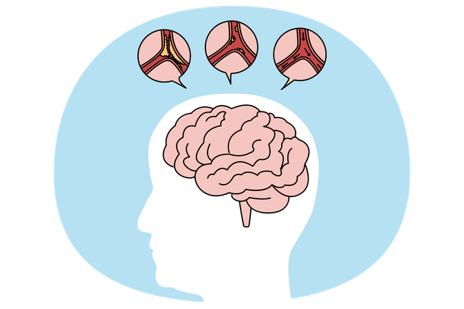 Medical representation of human brain stroke  Illustration