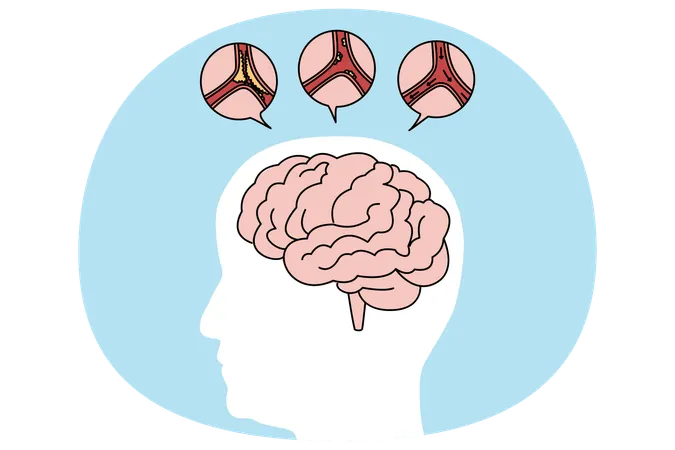 Medical representation of human brain stroke  Illustration
