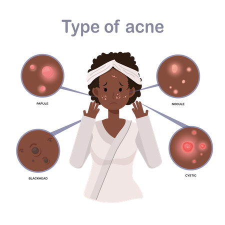 Menina com acne no rosto  Ilustração