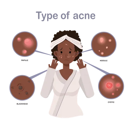 Menina com acne no rosto  Ilustração