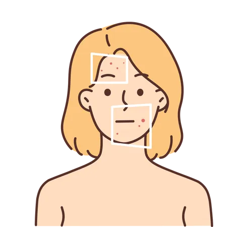 Menina com sinais de acne no rosto  Ilustração