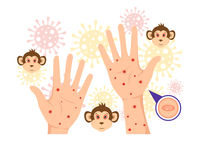 Monkeypox Virus  Illustration