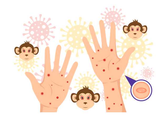 Monkeypox Virus  イラスト