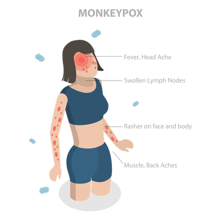 Monkeypox Virus Symptom  Illustration