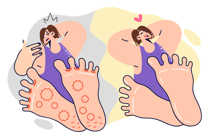 Mujer con hongos en los pies antes y después de usar ungüento medicinal  Ilustración