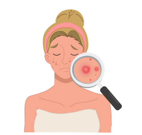 Mujer con grave problema de acné facial  Ilustración