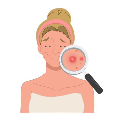Mulher com grave problema de acne facial  Ilustração