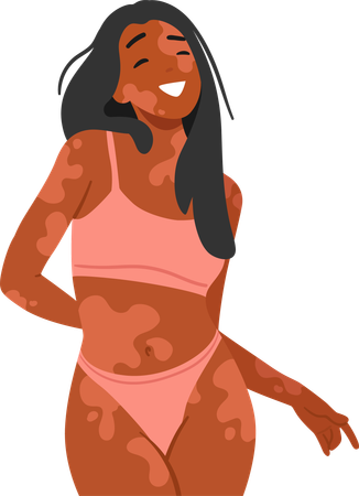 Mulher feliz com vitiligo abraça sua beleza única  Ilustração