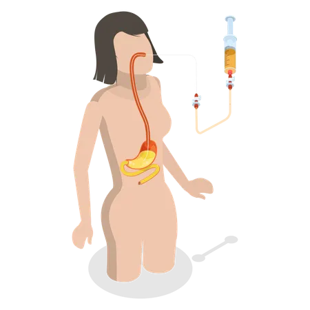 3 D Isometric Flat Vector Conceptual Illustration Of PEG Nasogastric Tube Passed Through The Nose To Stomach Illustration