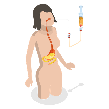 Nasogastric Tube Passed Through Nose to Stomach  Illustration