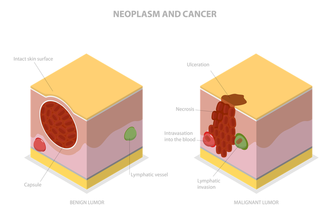 Neoplasia e Câncer  Ilustração