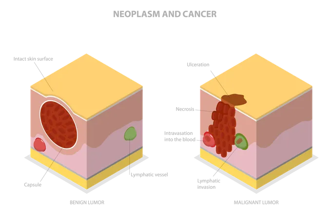 Neoplasia e Câncer  Ilustração