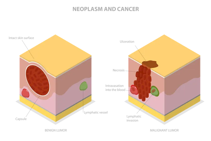 3 D Isometric Flat Vector Conceptual Illustration Of Neoplasm And Cancer Tumor Development Illustration