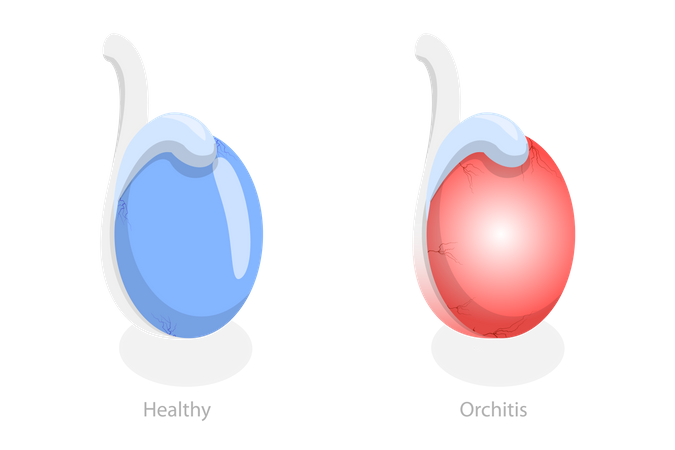 Orchite et inflammation des testicules  Illustration