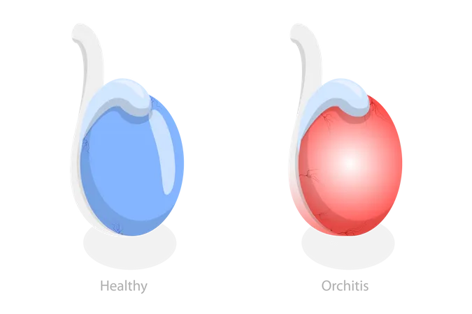 Orchite et inflammation des testicules  Illustration