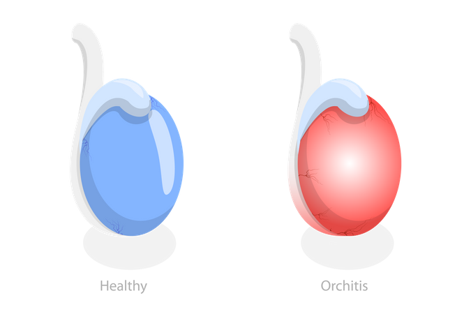 Orchitis and Inflammation of Testes  Illustration