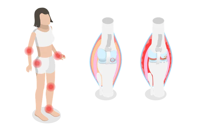3 D Isometric Flat Vector Conceptual Illustration Of Rheumatism Osteoarthritis And Rheumatoid Arthritis Illustration
