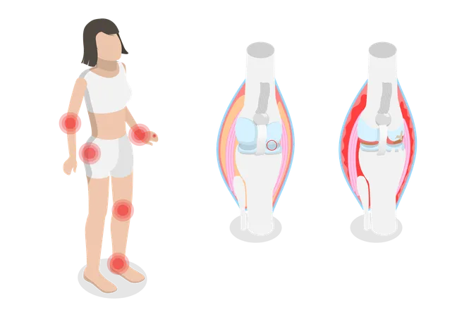 Osteoartrite e artrite reumatóide  Ilustração