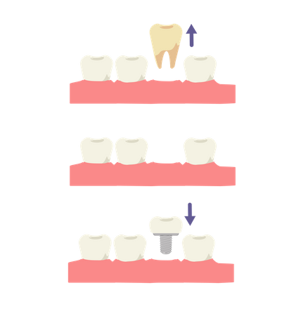 Processus d'implantation d'outils  Illustration