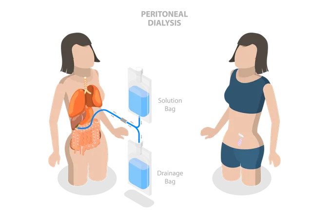 3 D Isometric Flat Vector Conceptual Illustration Of Peritoneal Dialysis Explanation Diagram Illustration