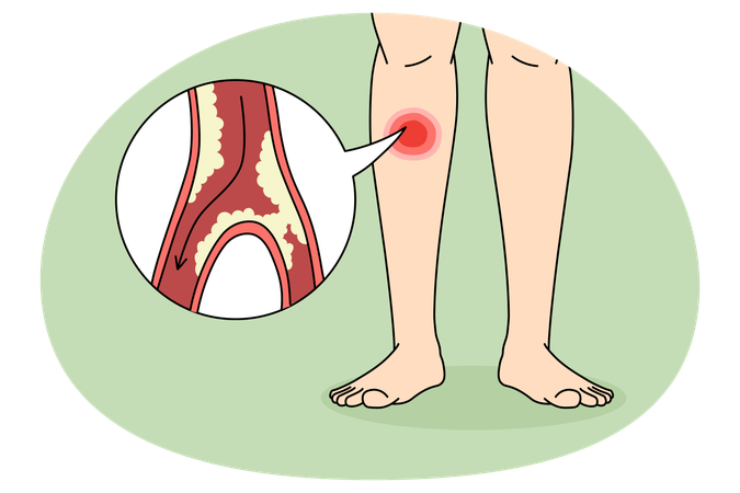 Person suffer from PAD disease in legs  Illustration