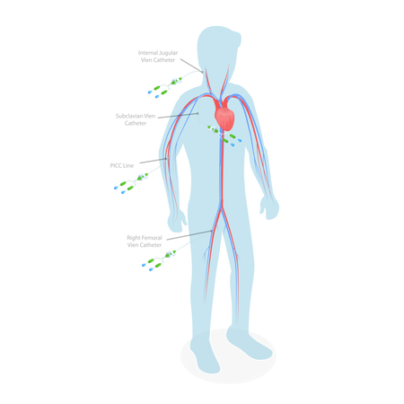 PICC Line  Illustration