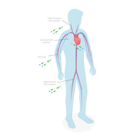 PICC Line  Illustration