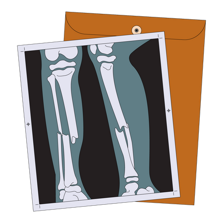 Radiografía de pierna rota  Ilustración
