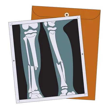 Radiografía de pierna rota  Ilustración