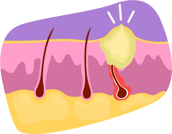 Pimple with ingrown  Illustration