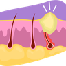 illustrations for pimple with ingrown