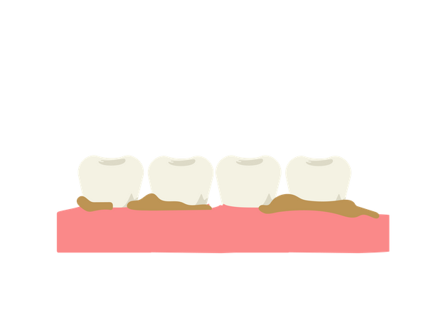 Placa y sarro en los dientes.  Ilustración