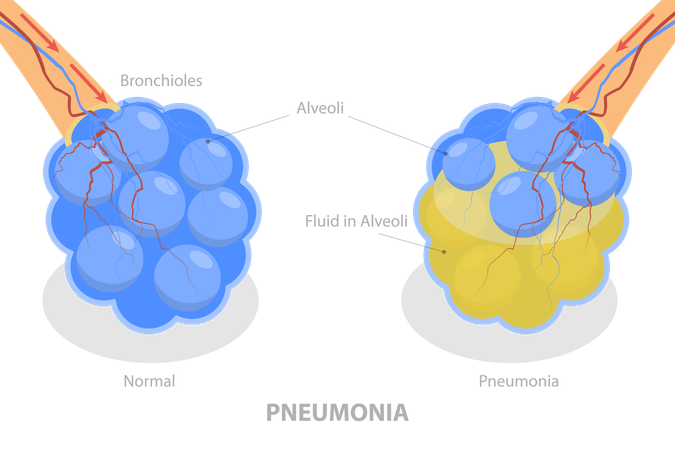 Pneumonia disease  Illustration